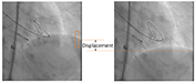 Convolutional Neural Networks (CNN) Applied to Respiratory Motion Detection in Fluoroscopic Frames thumbnail